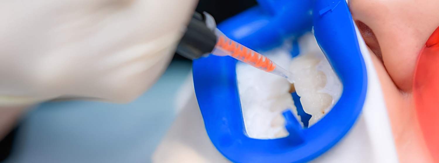 Композитная реставрация зубов