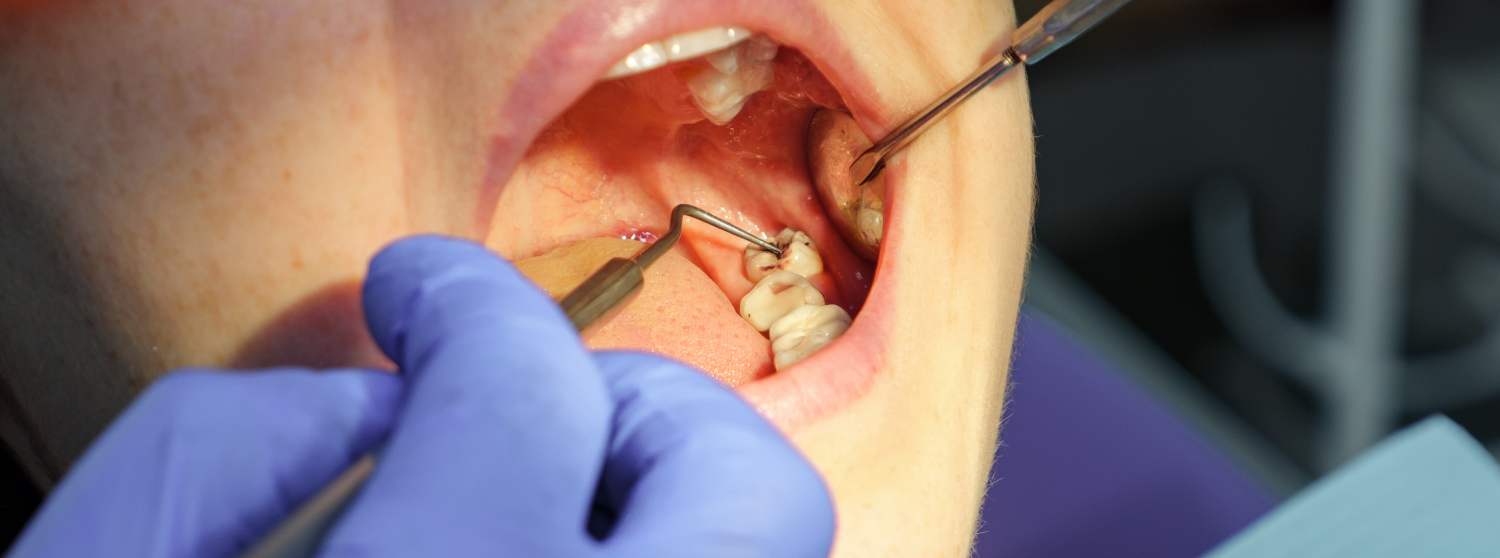 Лечение кариеса у детей