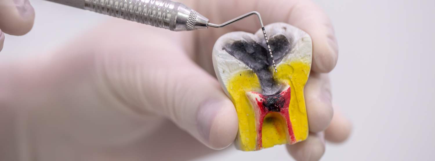 Лечение пульпита постоянных зубов под наркозом