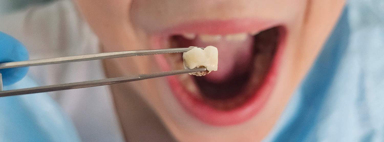 Удаление молочных зубов под наркозом