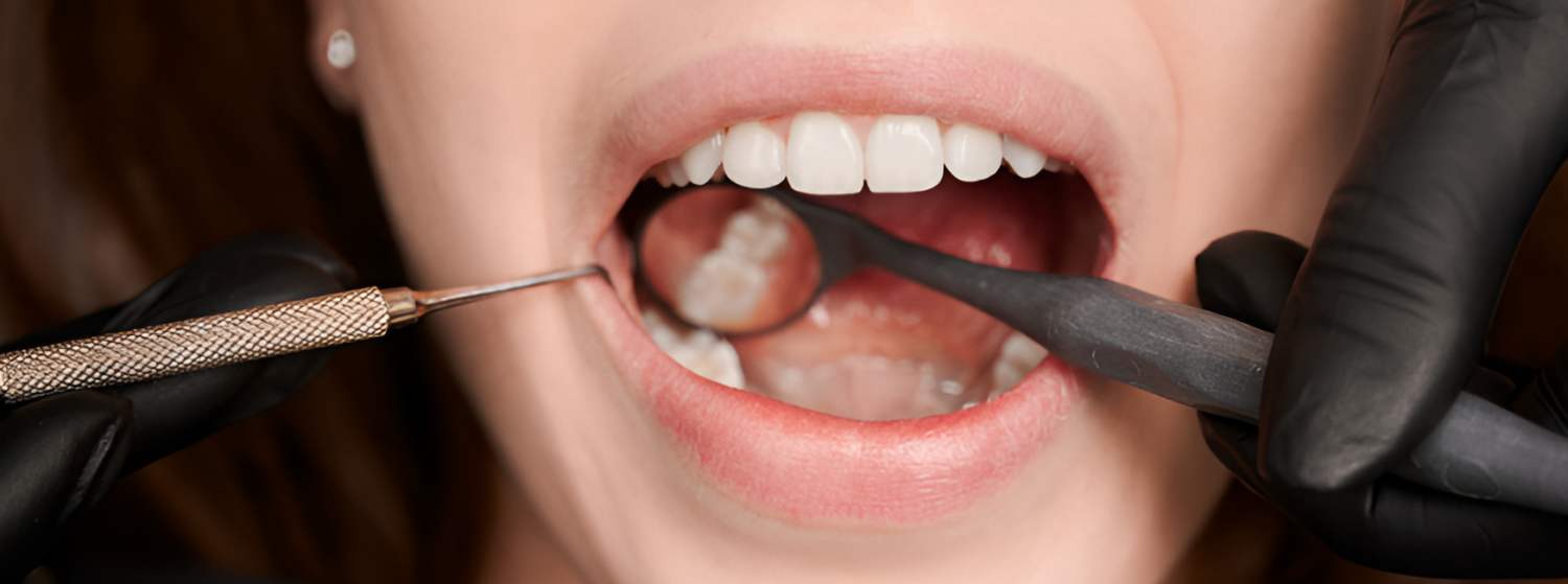 Реставрация зубов