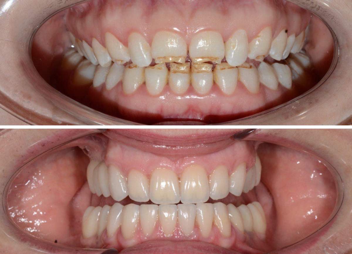 Эстетическое и функциональное восстановление зубов