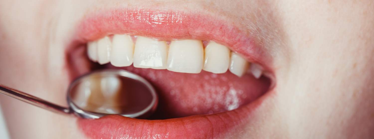 Лечение чувствительности зубов