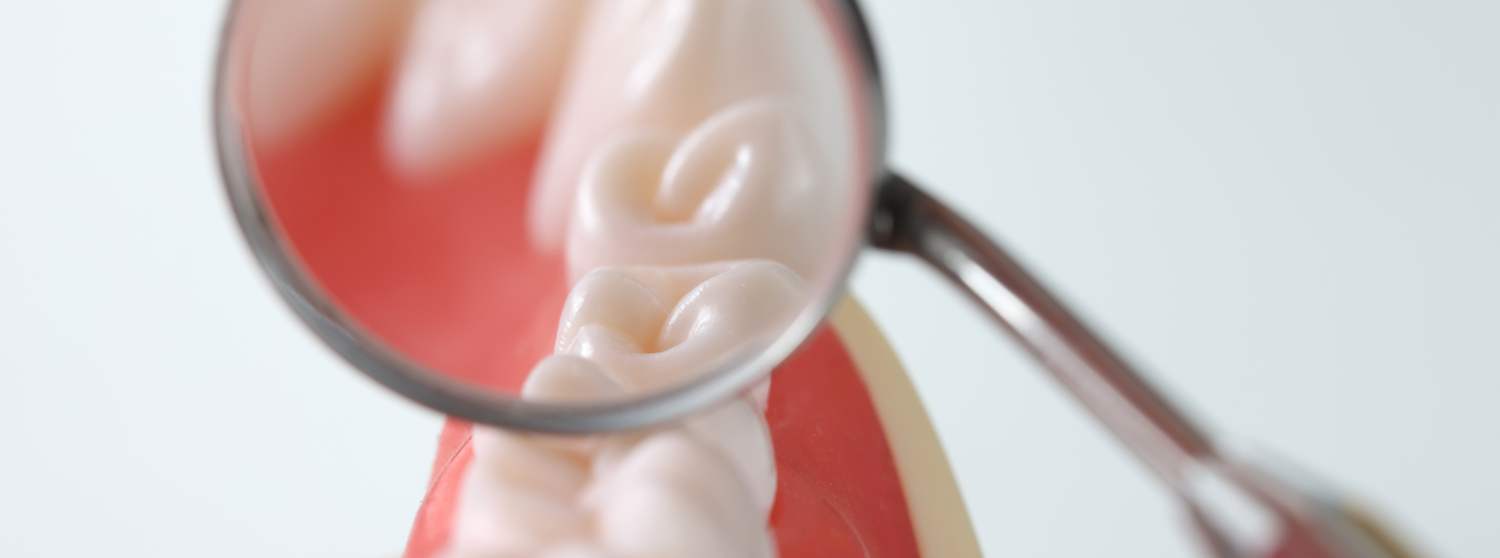 Лечение пародонтита