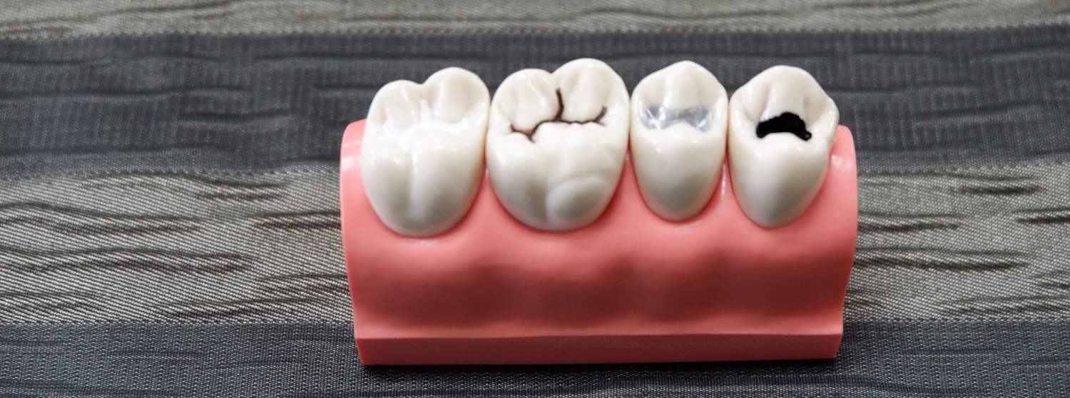 Лечение кариеса постоянных зубов под наркозом