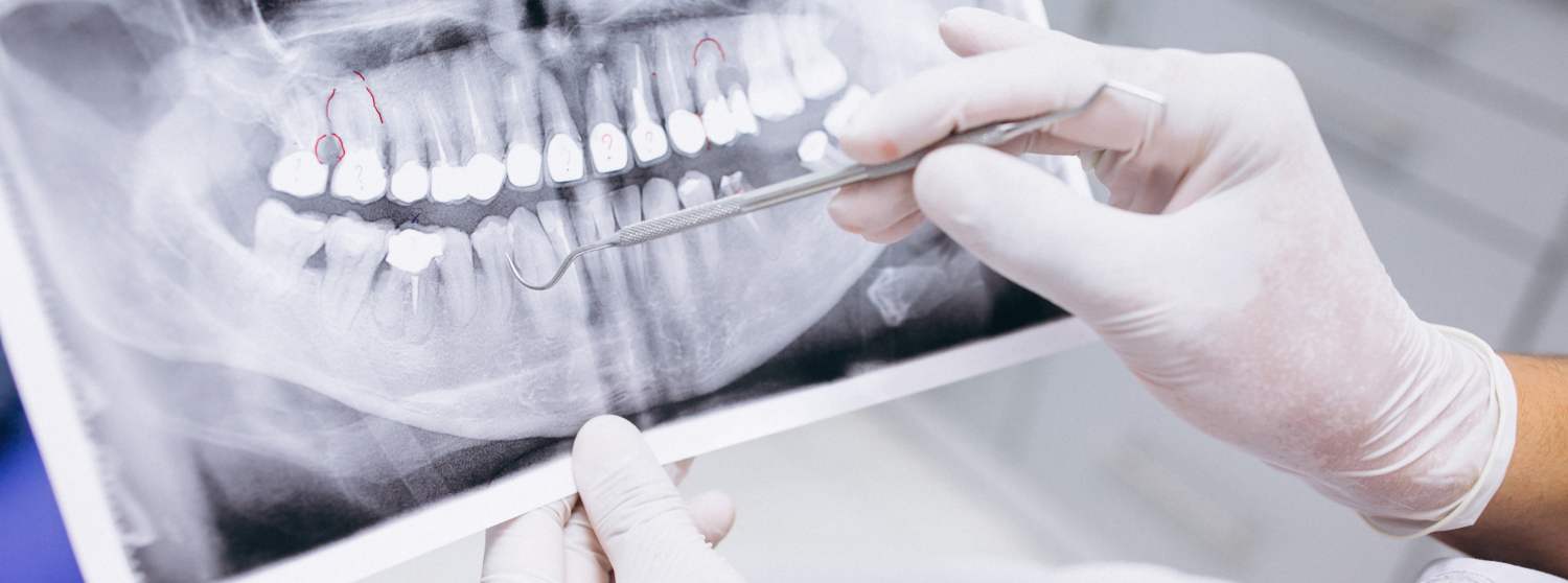 Имплантация зубов по технологии Все на 4