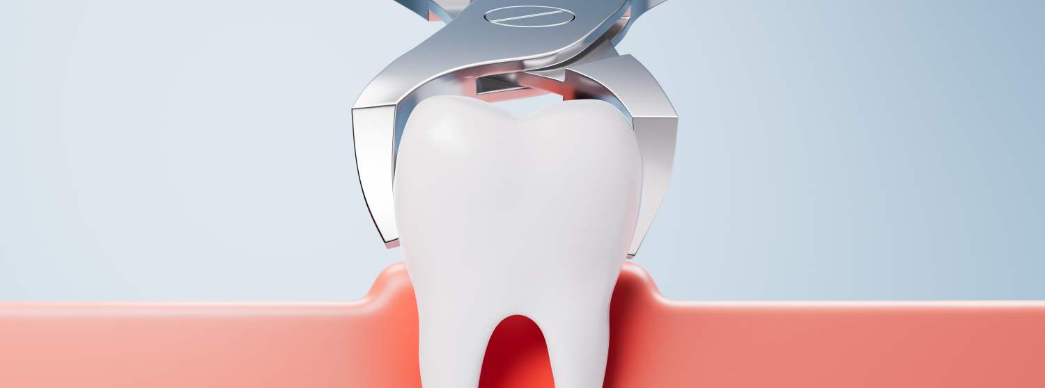 Удаление зубов (хирургическое)