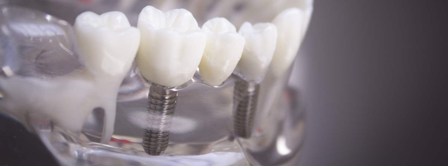 Имплантация Имплантация