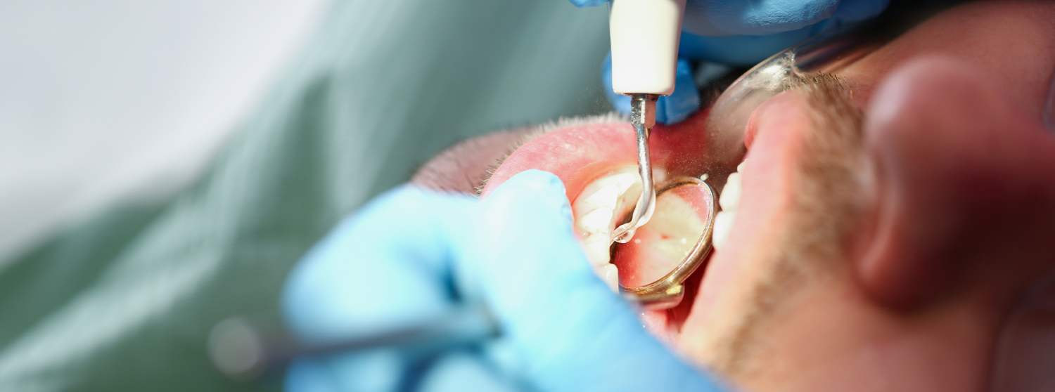 Удаление кисты зуба