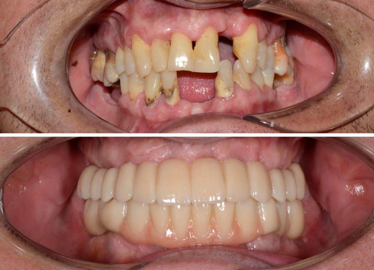 Имплантация