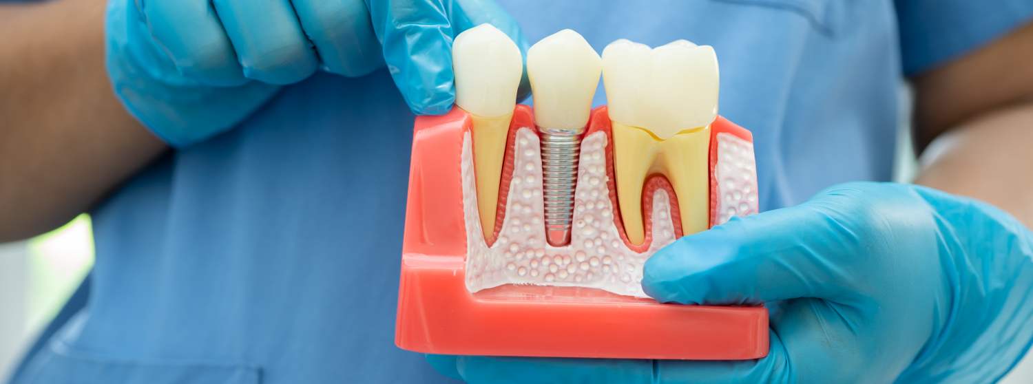 Имплантация одного зуба