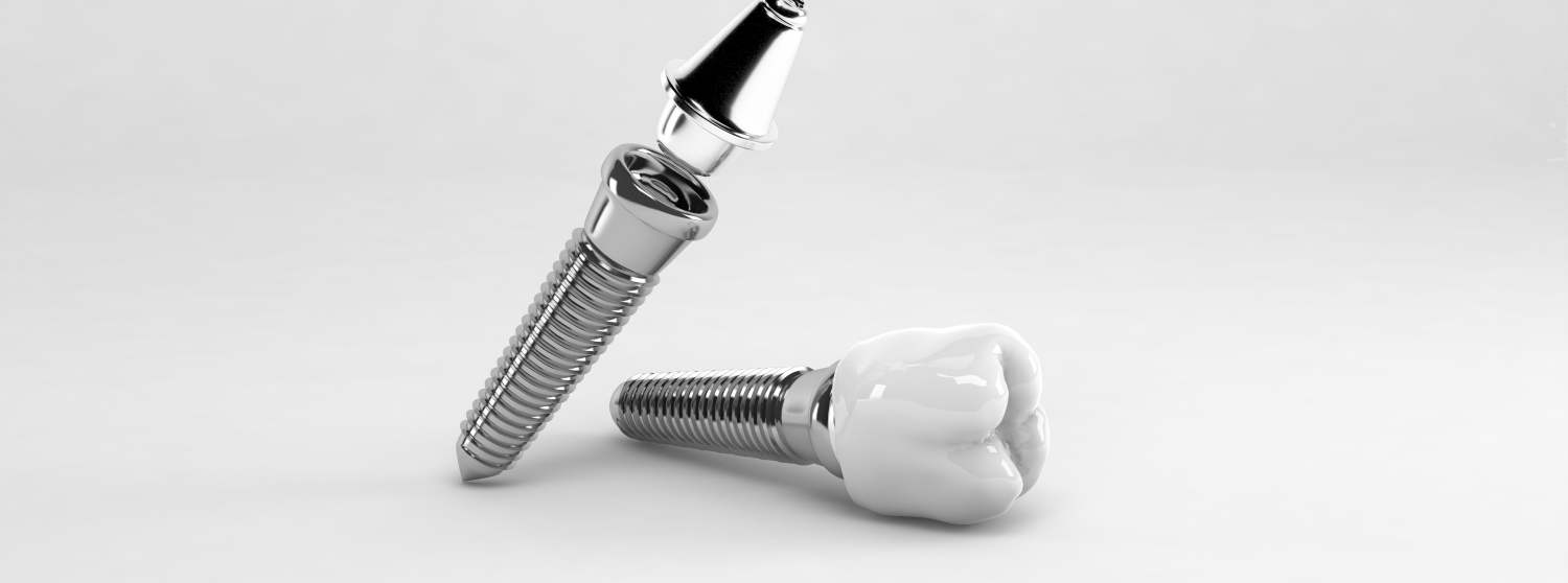 Имплантация верхних зубов Имплантация верхних зубов