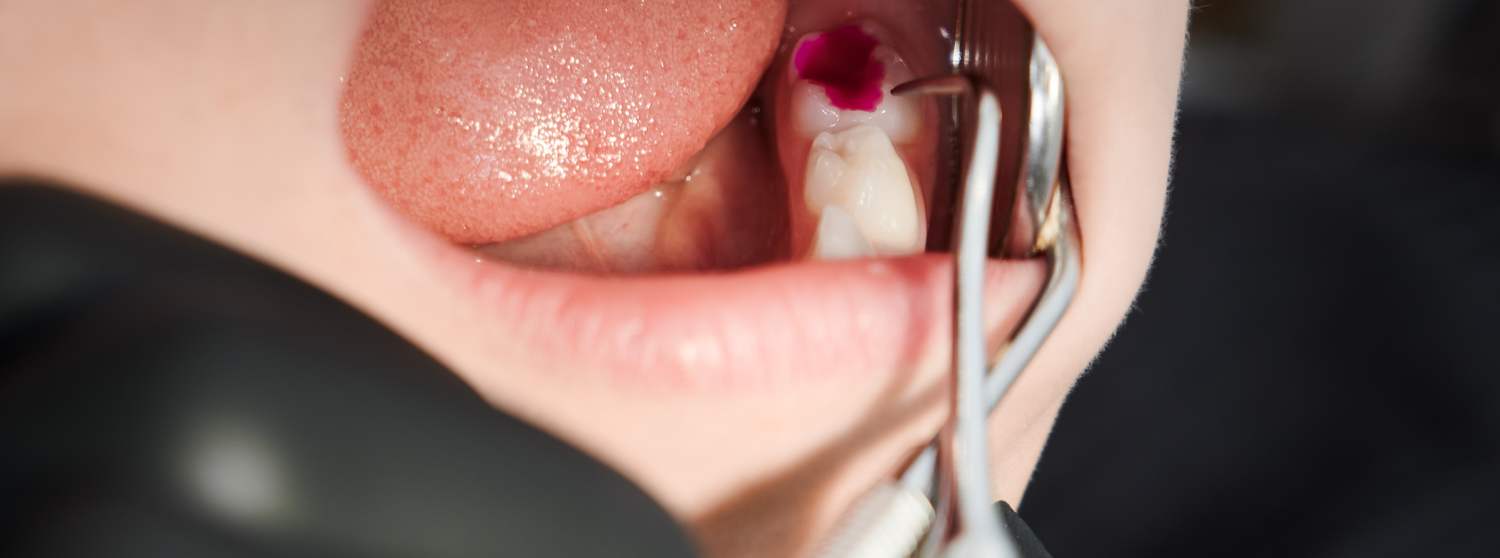 Лечение пульпита молочного зуба под наркозом