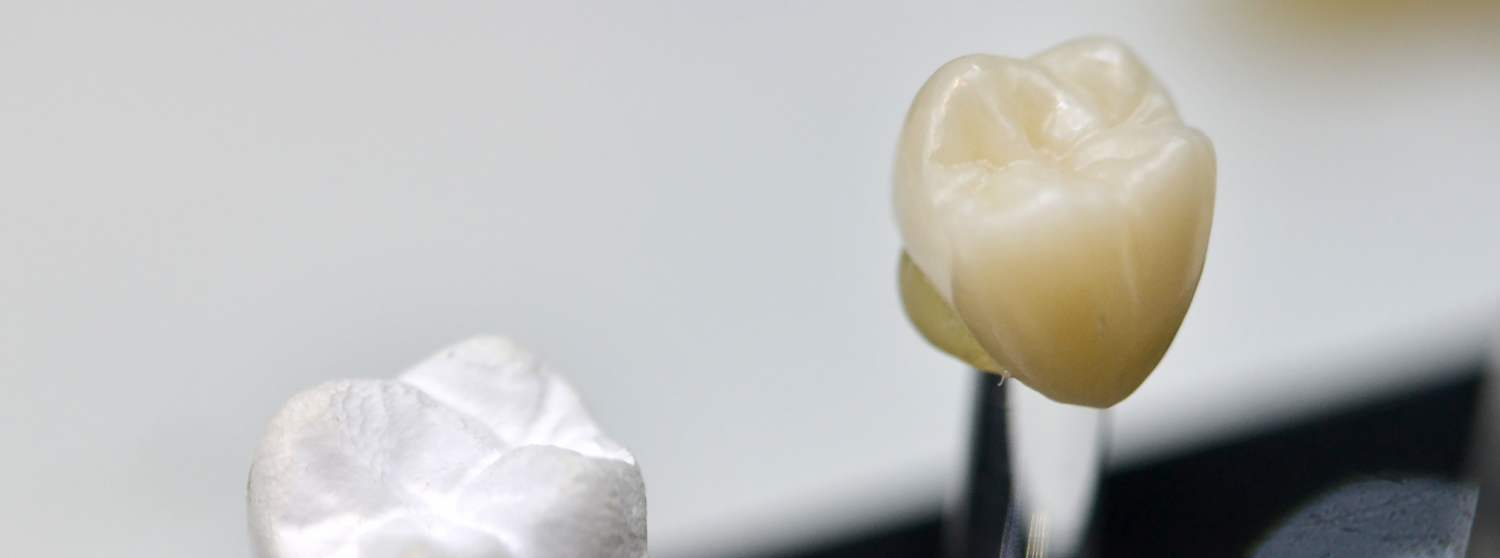 Установка коронок