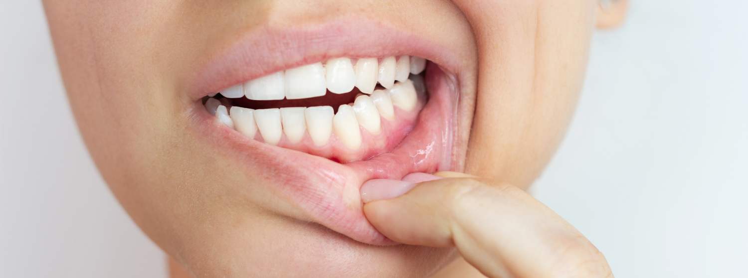 Лечение слизистой полости рта