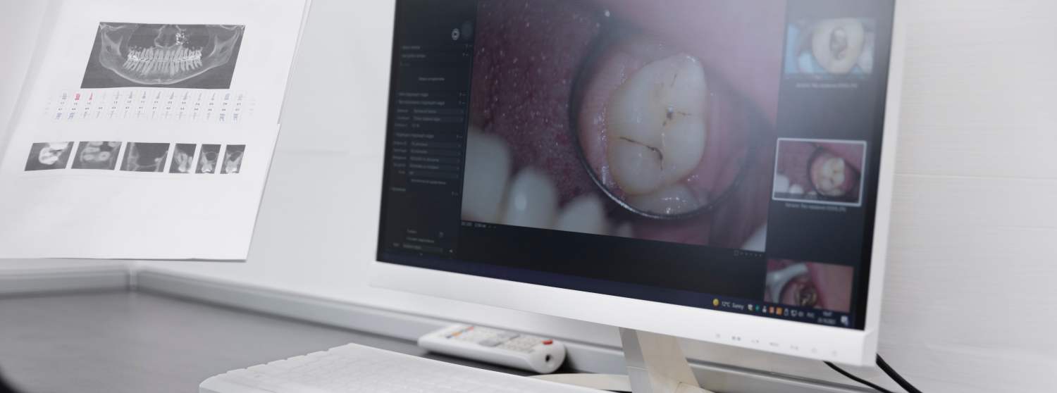 Рентген зуба (радиовизиография)