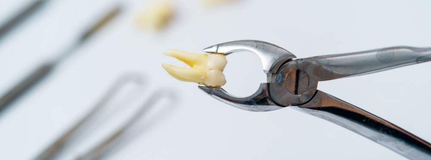 Удаление зубов мудрости